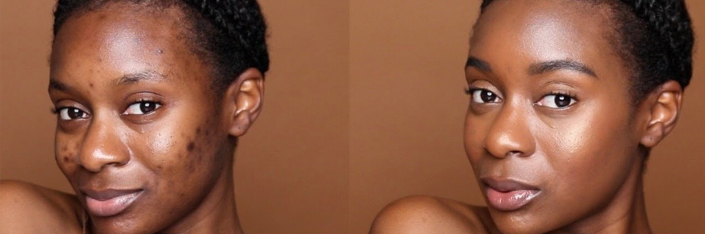 Two pictures of a woman before and after effect, showcasing the transformative effect of acne treatment after teladoc dermatology.